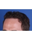 After Hair Transplant&nbsp;Front